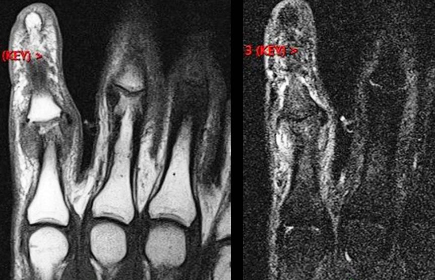 Figure 2 for case volar plate tear of proximal interphalangeal joint of finger ( RID2413 )